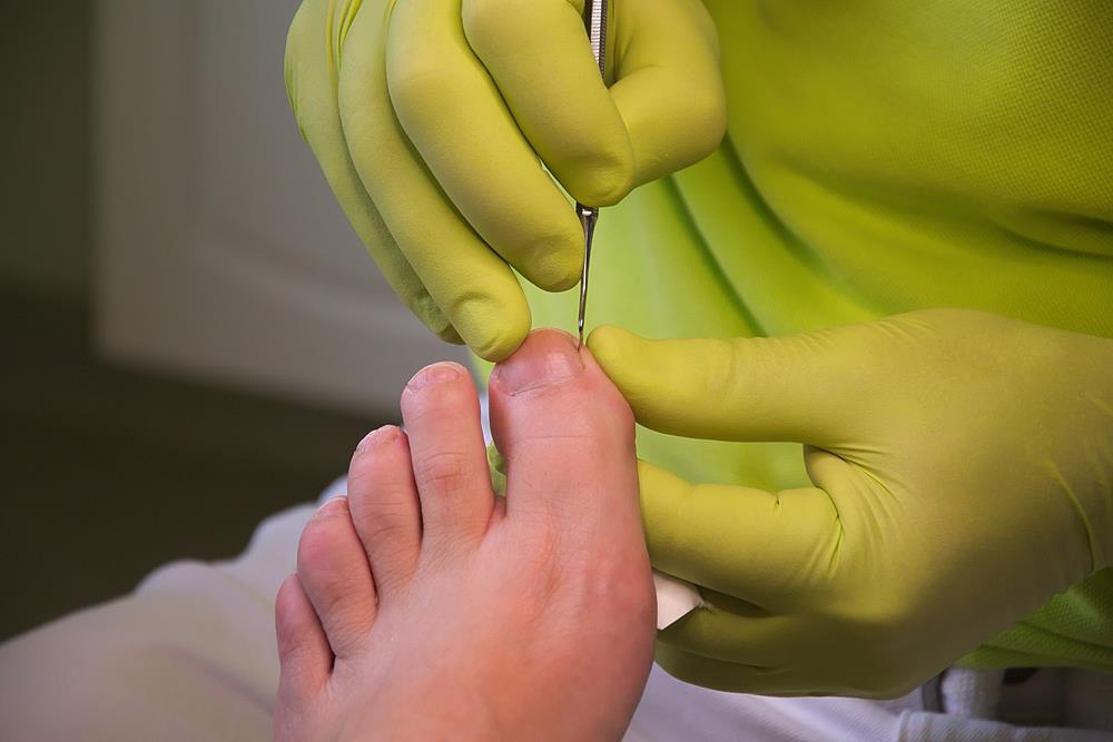 Ingrown Toenails Columbus, OH 